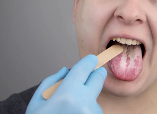 Czy pleśniawki jamy ustnej są groźne dla zdrowia?