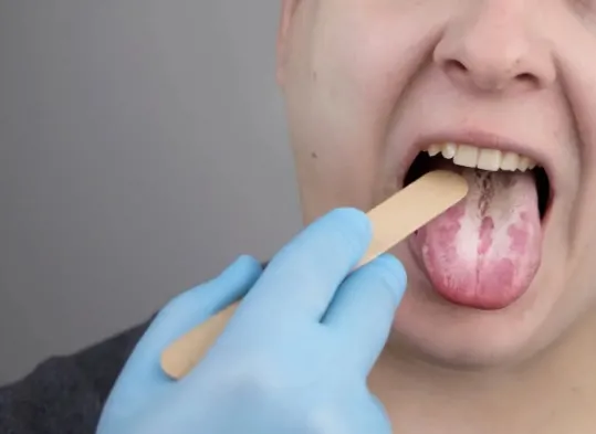 Czy pleśniawki jamy ustnej są groźne dla zdrowia?