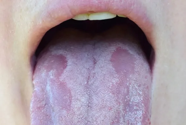 Kiedy pleśniawki w jamie ustnej mogą stać się niebezpieczne?