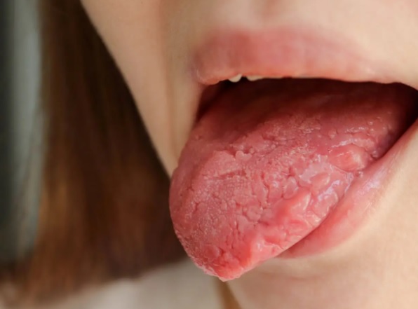 Czy pleśniawki w jamie ustnej mogą prowadzić do zakażeń?