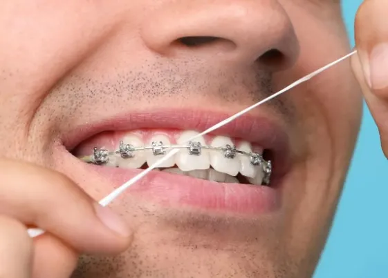 Jakie produkty do czyszczenia zębów sprawdzają się najlepiej przy aparacie?