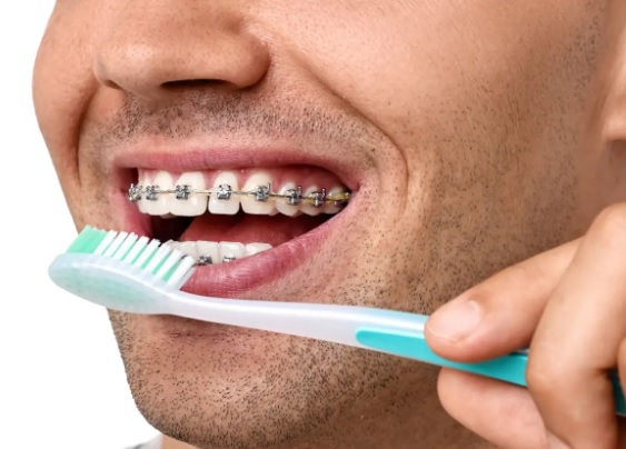 Jak często powinno się szczotkować zęby podczas noszenia aparatu ortodontycznego?